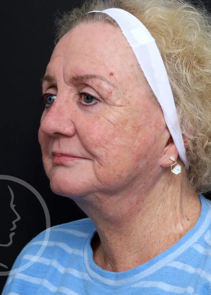 Plastic Surgery Before and After Pictures in Jacksonville, FL - Garcia Facial Plastic Surgery