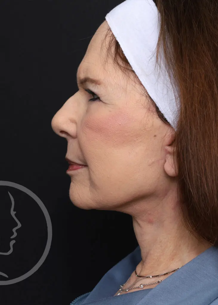 Plastic Surgery Before and After Pictures in Jacksonville, FL - Garcia Facial Plastic Surgery