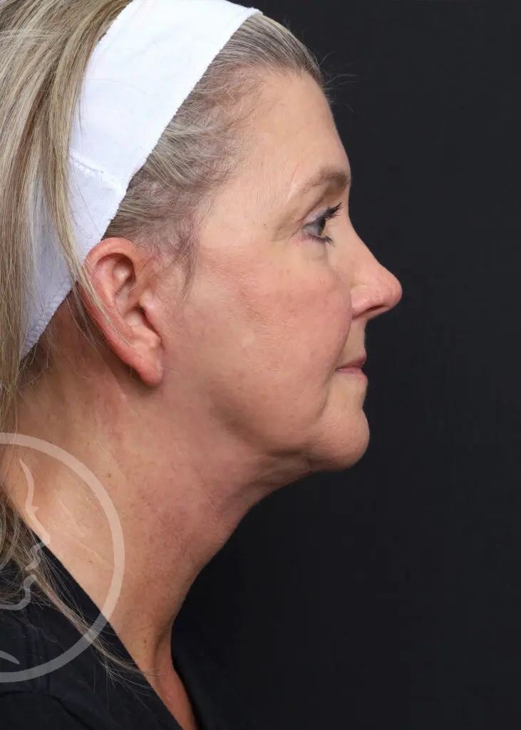 Plastic Surgery Before and After Pictures in Jacksonville, FL - Garcia Facial Plastic Surgery