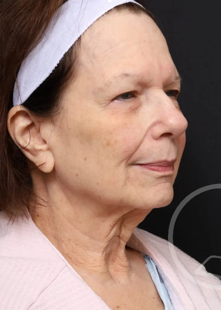 Plastic Surgery Before and After Pictures in Jacksonville, FL - Garcia Facial Plastic Surgery