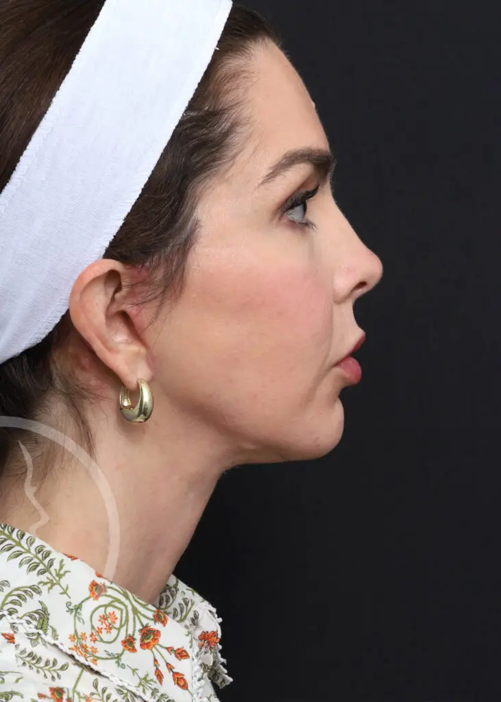 Plastic Surgery Before and After Pictures in Jacksonville, FL - Garcia Facial Plastic Surgery