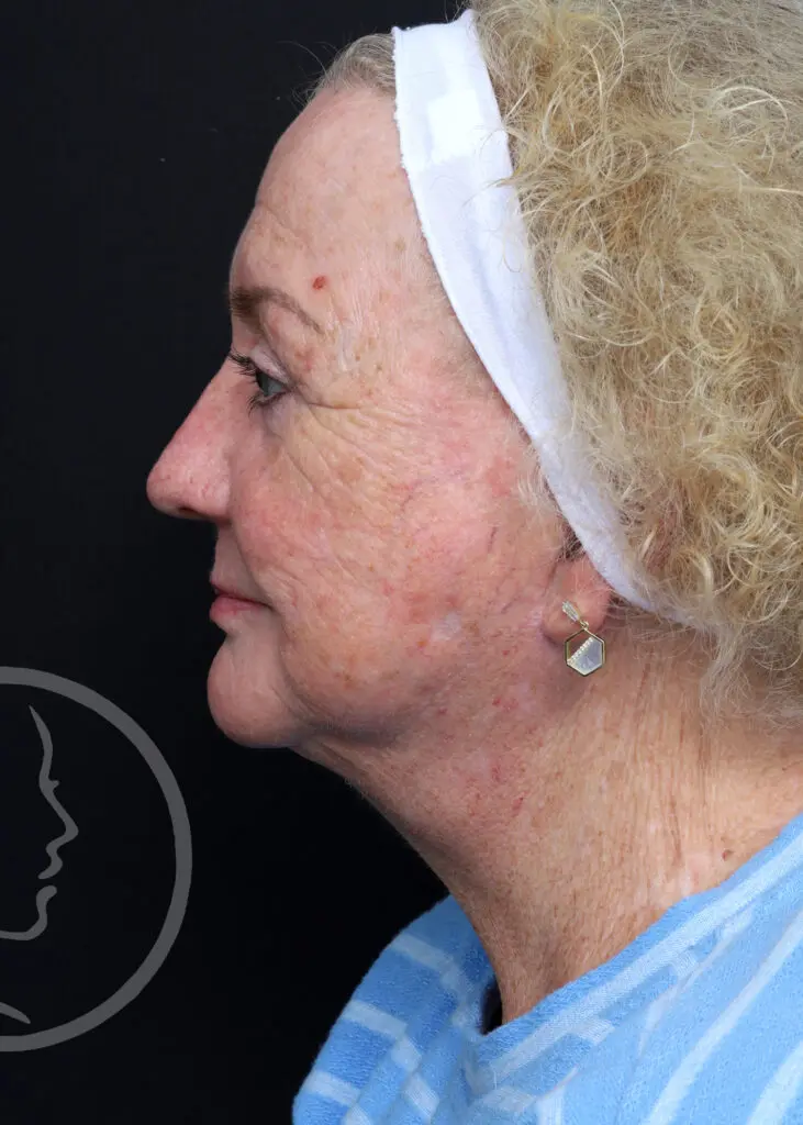 Plastic Surgery Before and After Pictures in Jacksonville, FL - Garcia Facial Plastic Surgery