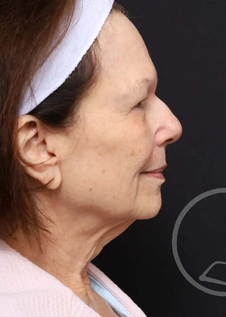 Plastic Surgery Before and After Pictures in Jacksonville, FL - Garcia Facial Plastic Surgery