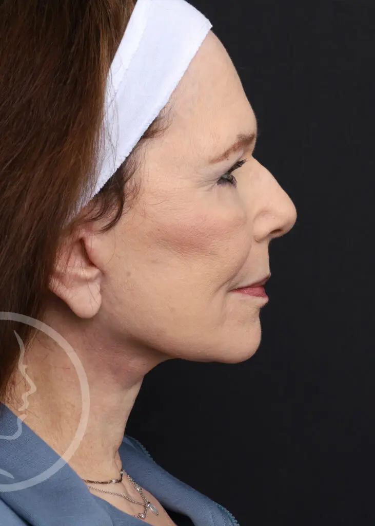 Plastic Surgery Before and After Pictures in Jacksonville, FL - Garcia Facial Plastic Surgery