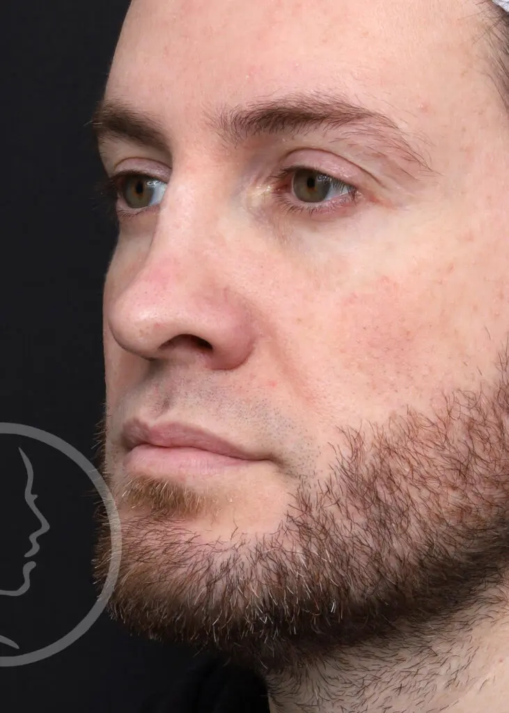 Plastic Surgery Before and After Pictures in Jacksonville, FL - Garcia Facial Plastic Surgery