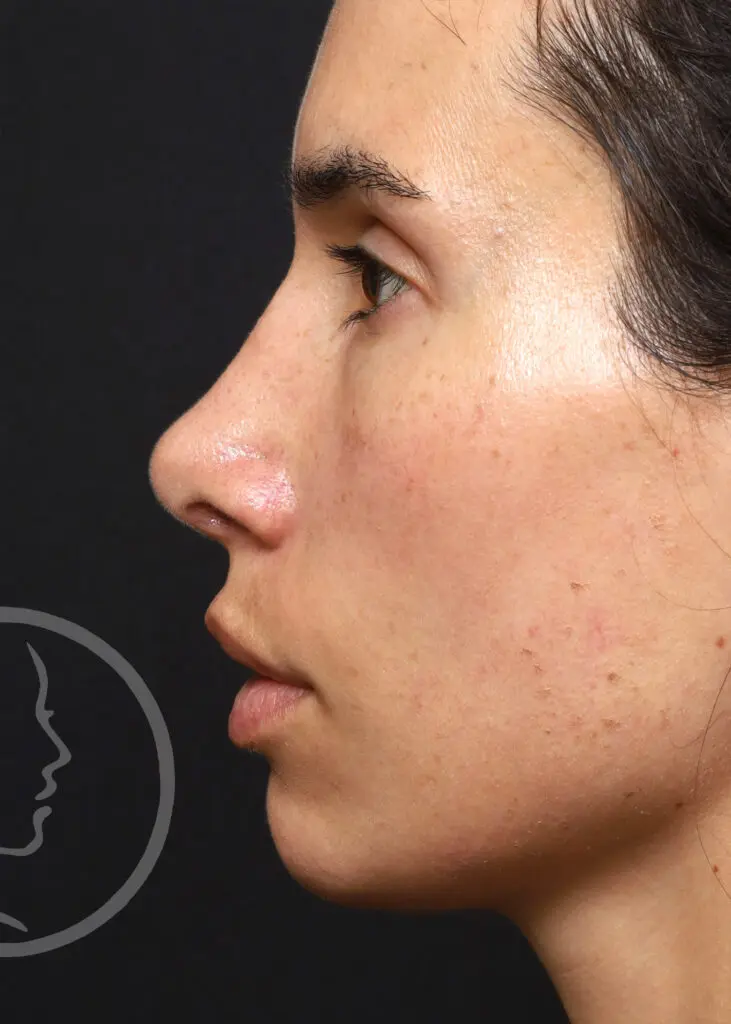 Plastic Surgery Before and After Pictures in Jacksonville, FL - Garcia Facial Plastic Surgery