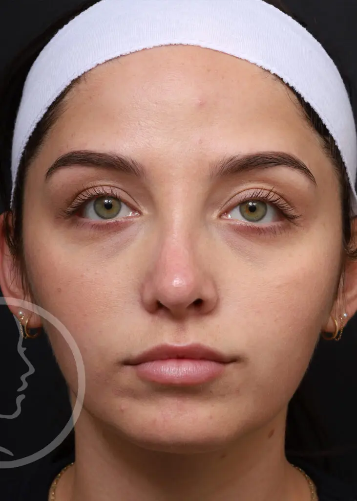 Plastic Surgery Before and After Pictures in Jacksonville, FL - Garcia Facial Plastic Surgery