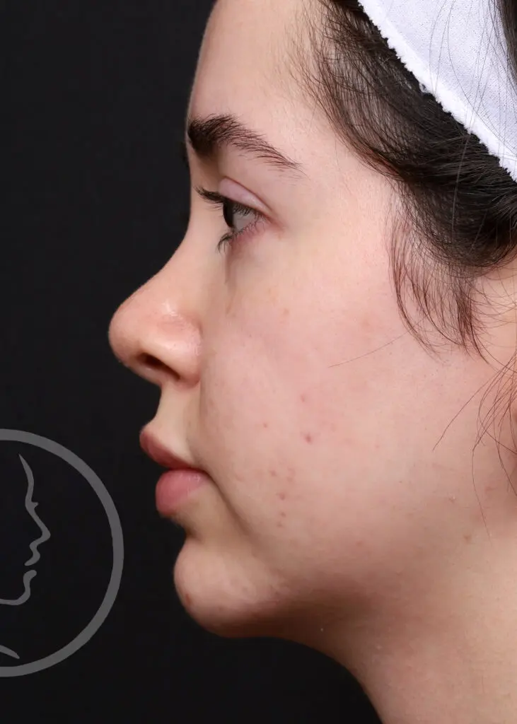 Plastic Surgery Before and After Pictures in Jacksonville, FL - Garcia Facial Plastic Surgery