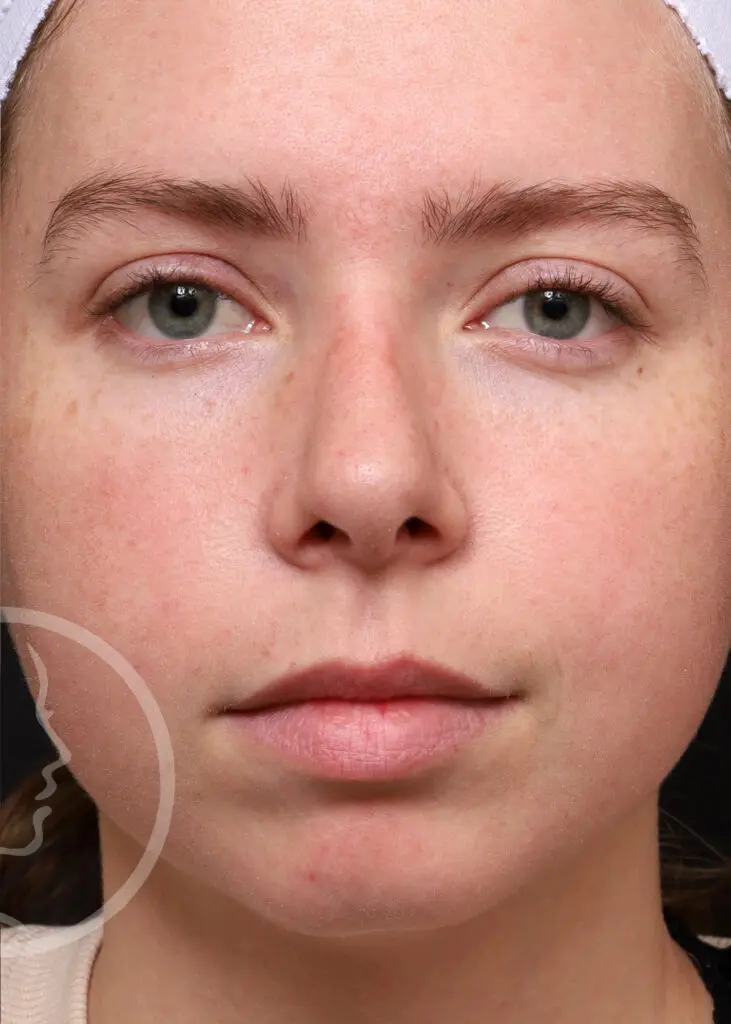 Plastic Surgery Before and After Pictures in Jacksonville, FL - Garcia Facial Plastic Surgery