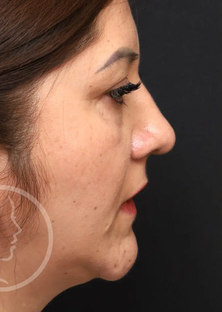 Plastic Surgery Before and After Pictures in Jacksonville, FL - Garcia Facial Plastic Surgery