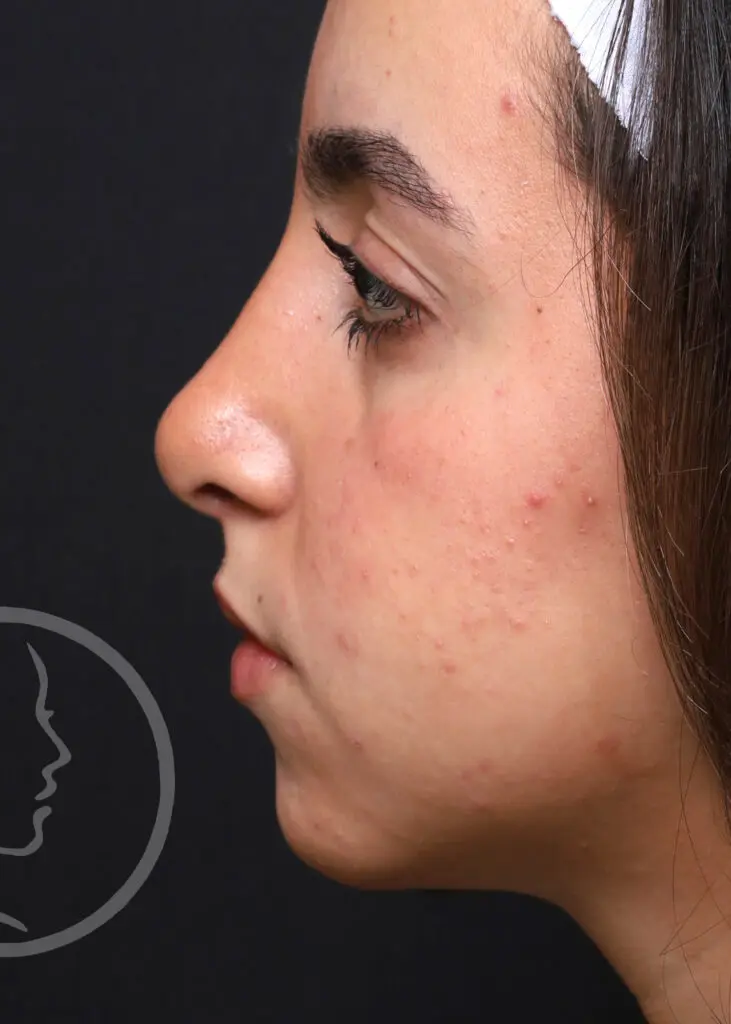 Plastic Surgery Before and After Pictures in Jacksonville, FL - Garcia Facial Plastic Surgery