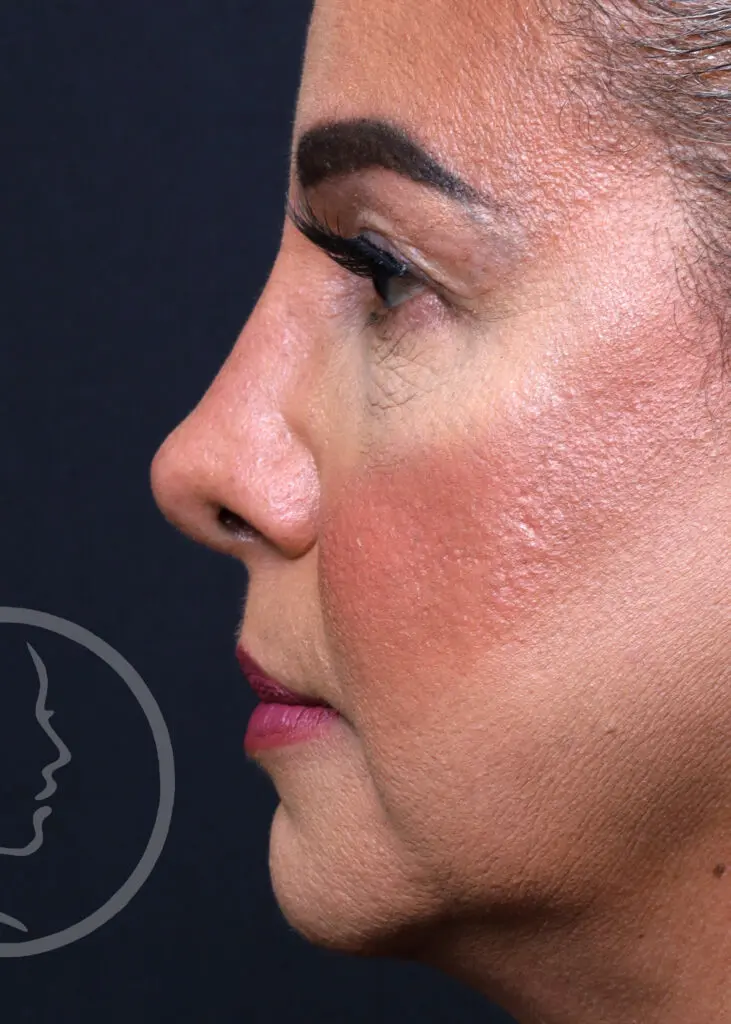 Plastic Surgery Before and After Pictures in Jacksonville, FL - Garcia Facial Plastic Surgery