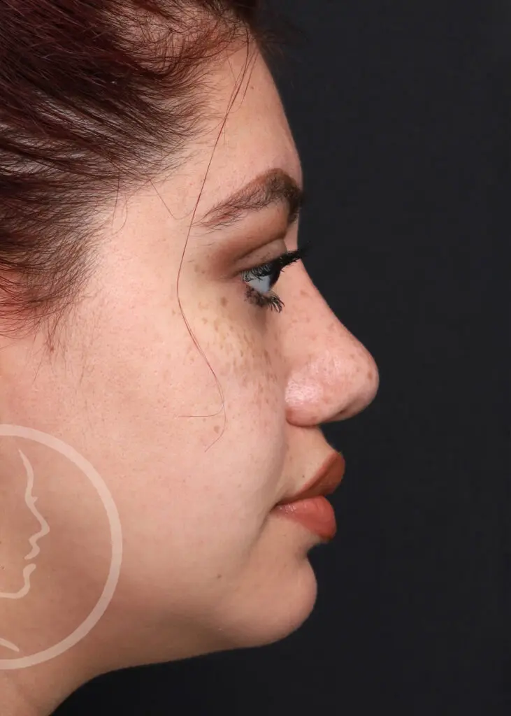 Plastic Surgery Before and After Pictures in Jacksonville, FL - Garcia Facial Plastic Surgery