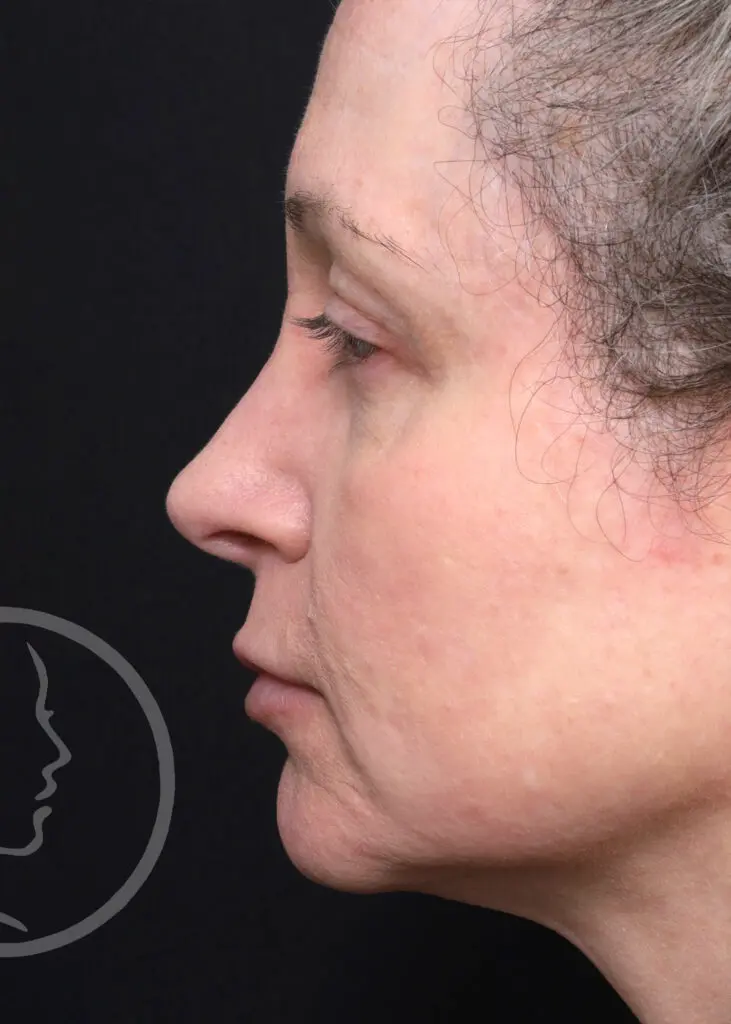 Plastic Surgery Before and After Pictures in Jacksonville, FL - Garcia Facial Plastic Surgery