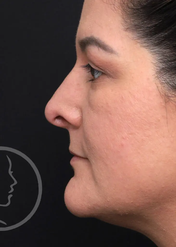 Plastic Surgery Before and After Pictures in Jacksonville, FL - Garcia Facial Plastic Surgery