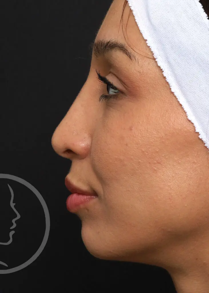 Plastic Surgery Before and After Pictures in Jacksonville, FL - Garcia Facial Plastic Surgery