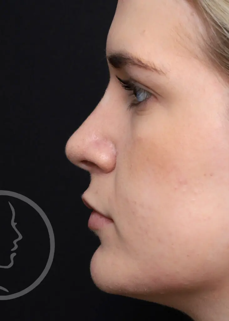 Plastic Surgery Before and After Pictures in Jacksonville, FL - Garcia Facial Plastic Surgery