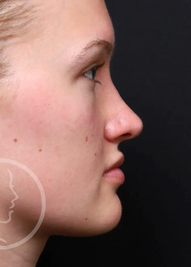 Plastic Surgery Before and After Pictures in Jacksonville, FL - Garcia Facial Plastic Surgery