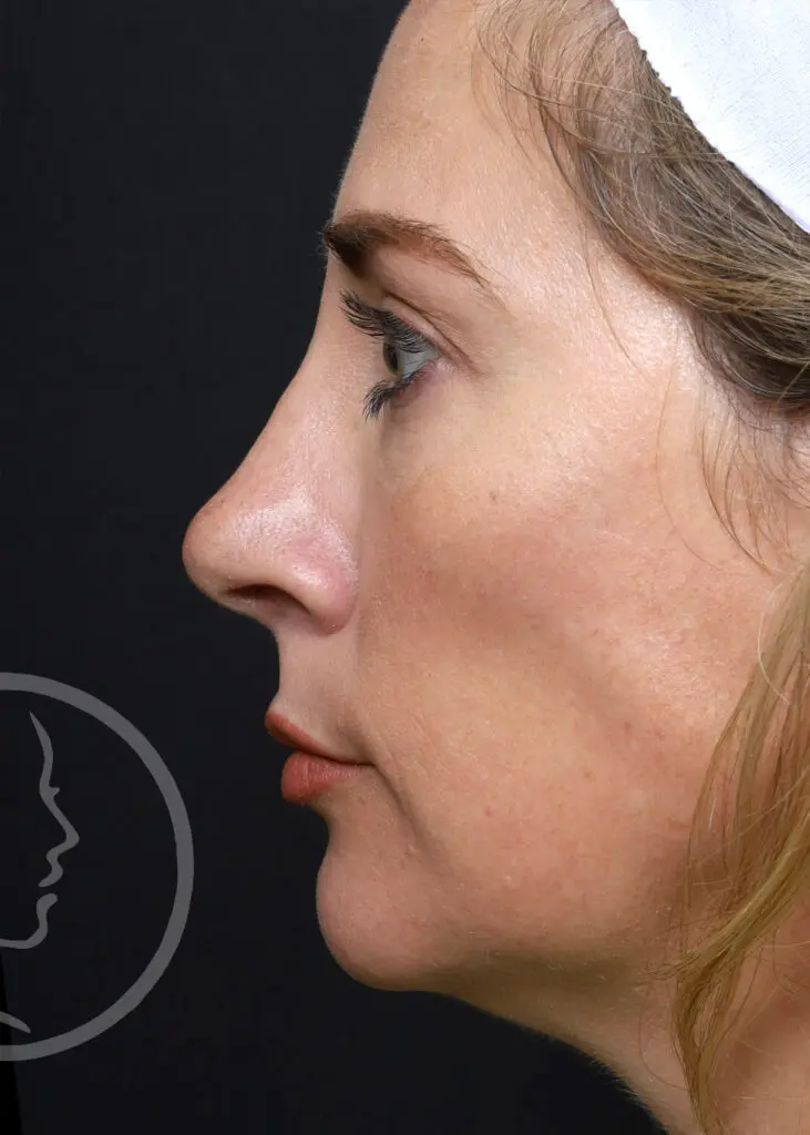 Plastic Surgery Before and After Pictures in Jacksonville, FL - Garcia Facial Plastic Surgery