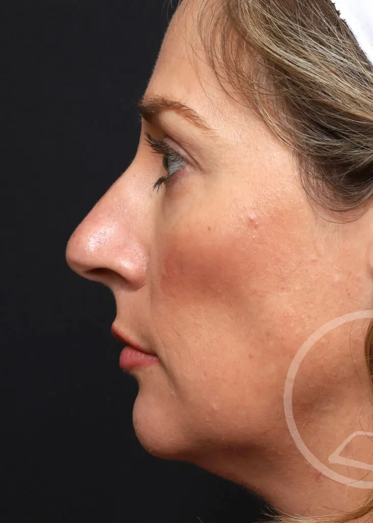Plastic Surgery Before and After Pictures in Jacksonville, FL - Garcia Facial Plastic Surgery
