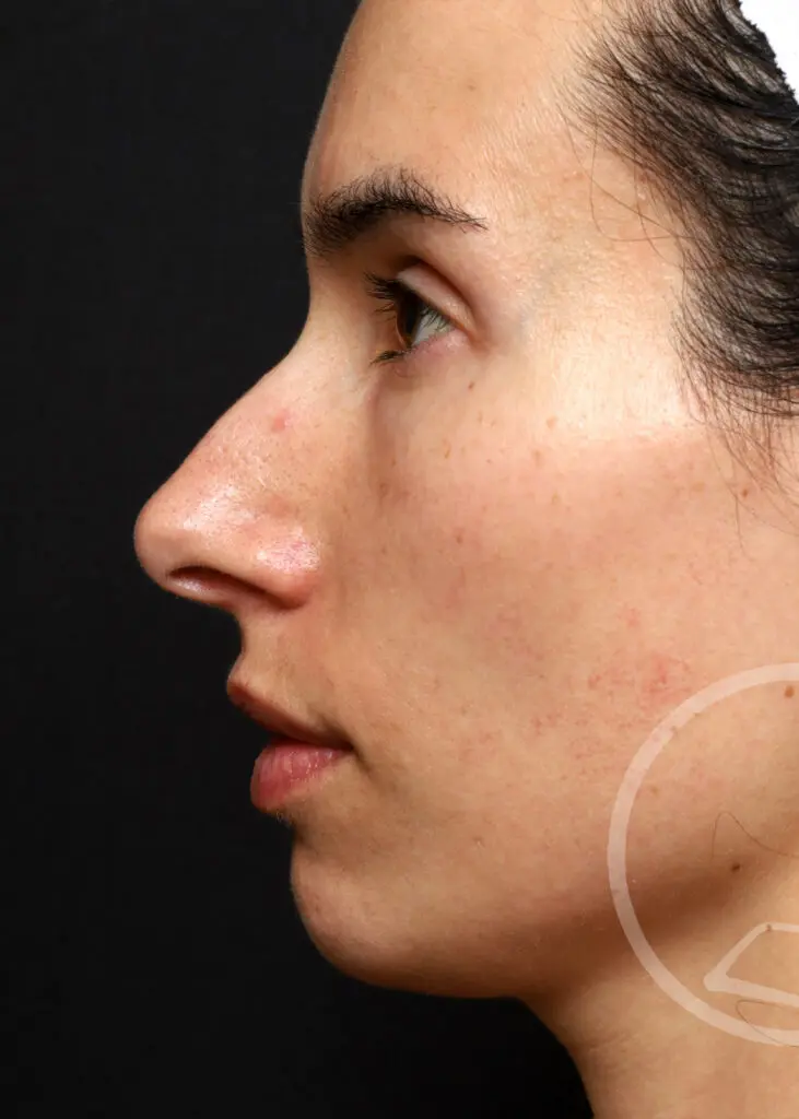 Plastic Surgery Before and After Pictures in Jacksonville, FL - Garcia Facial Plastic Surgery