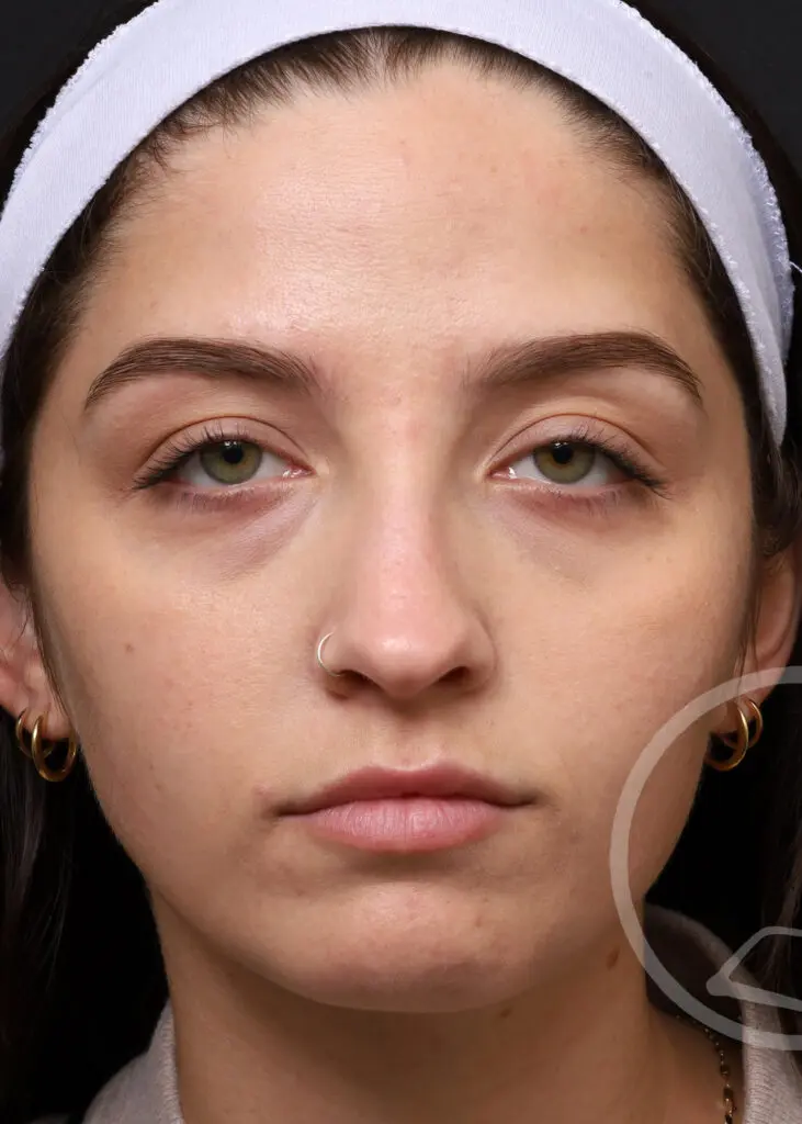 Plastic Surgery Before and After Pictures in Jacksonville, FL - Garcia Facial Plastic Surgery