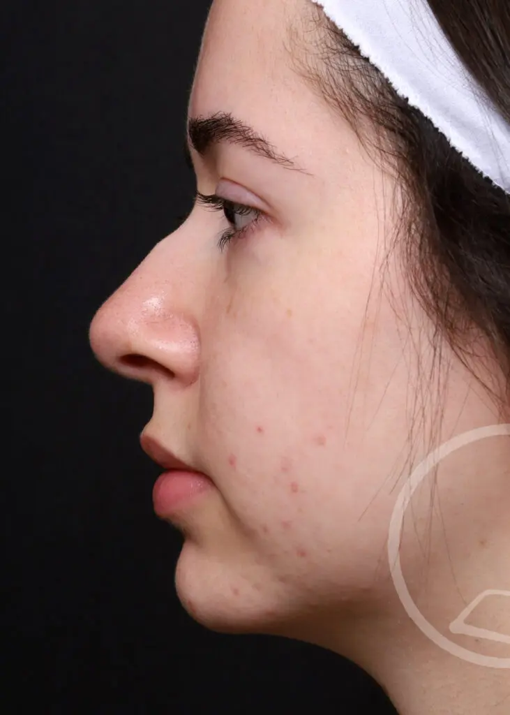 Plastic Surgery Before and After Pictures in Jacksonville, FL - Garcia Facial Plastic Surgery