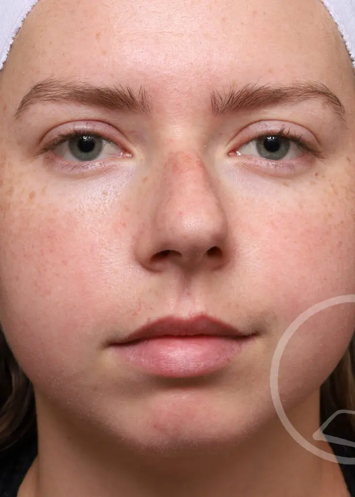 Plastic Surgery Before and After Pictures in Jacksonville, FL - Garcia Facial Plastic Surgery
