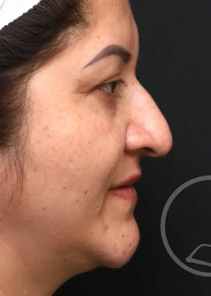 Plastic Surgery Before and After Pictures in Jacksonville, FL - Garcia Facial Plastic Surgery