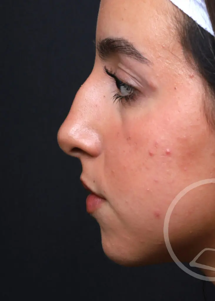Plastic Surgery Before and After Pictures in Jacksonville, FL - Garcia Facial Plastic Surgery