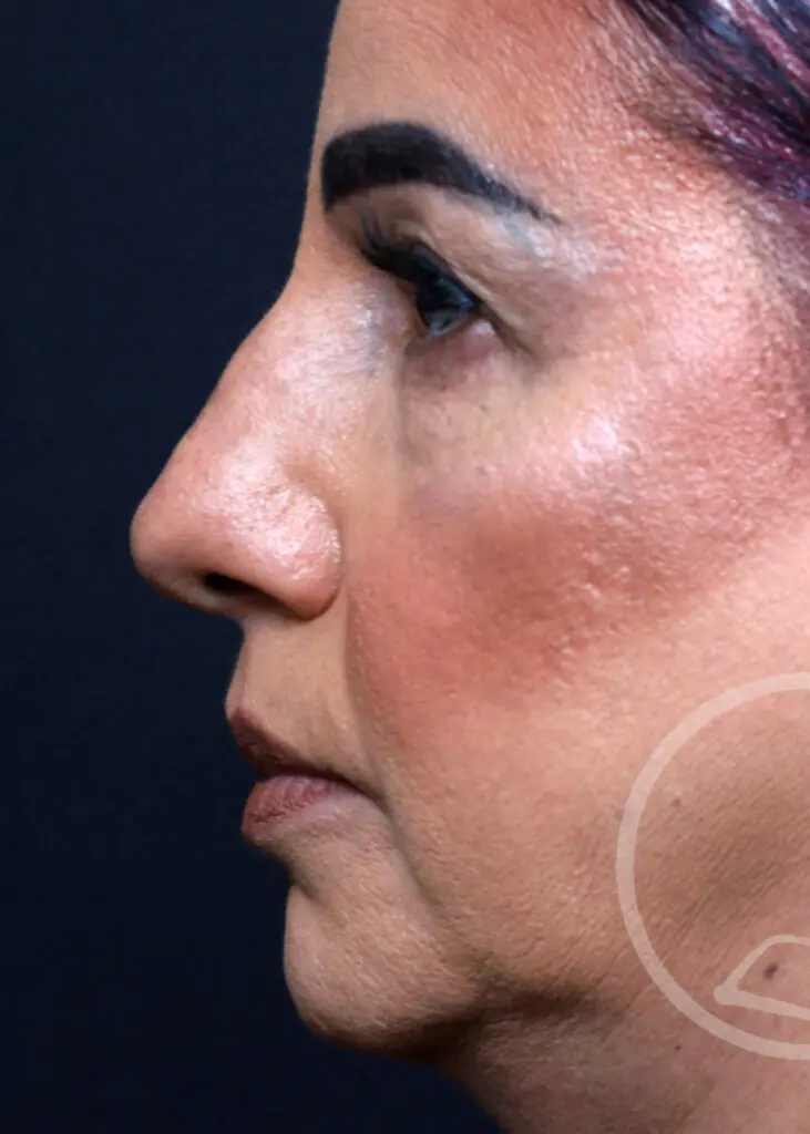 Plastic Surgery Before and After Pictures in Jacksonville, FL - Garcia Facial Plastic Surgery