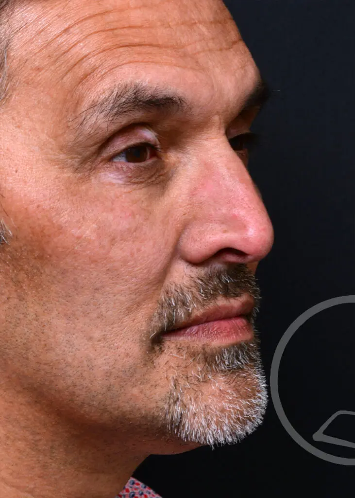 Plastic Surgery Before and After Pictures in Jacksonville, FL - Garcia Facial Plastic Surgery