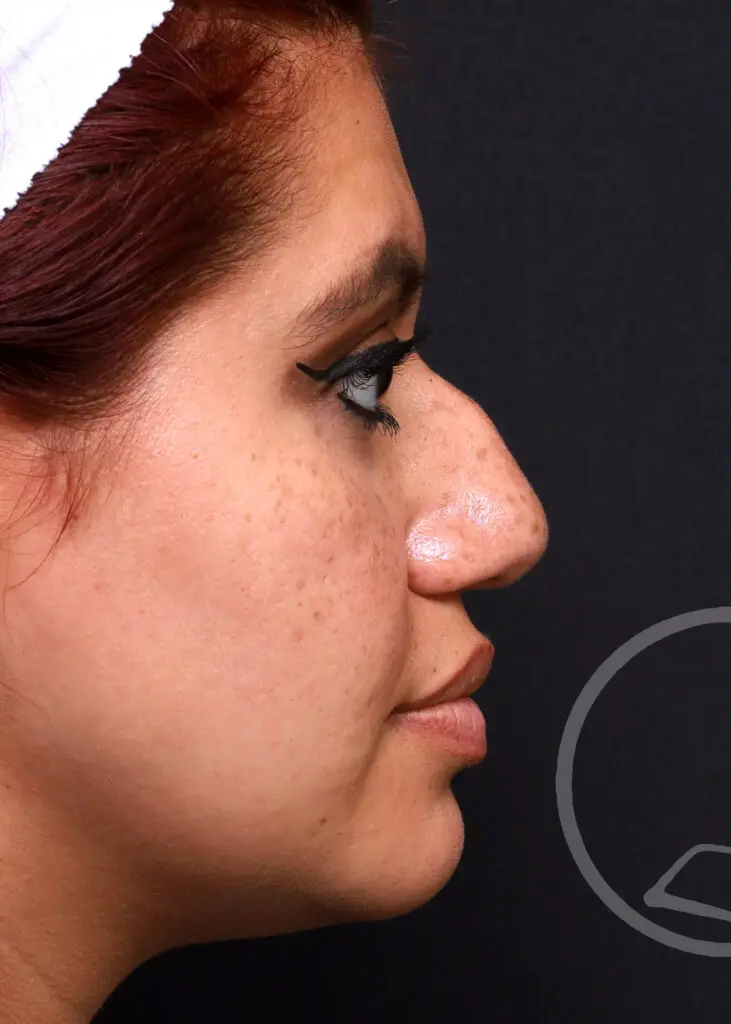 Plastic Surgery Before and After Pictures in Jacksonville, FL - Garcia Facial Plastic Surgery