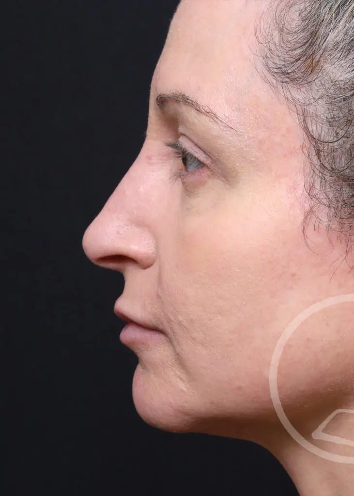 Plastic Surgery Before and After Pictures in Jacksonville, FL - Garcia Facial Plastic Surgery