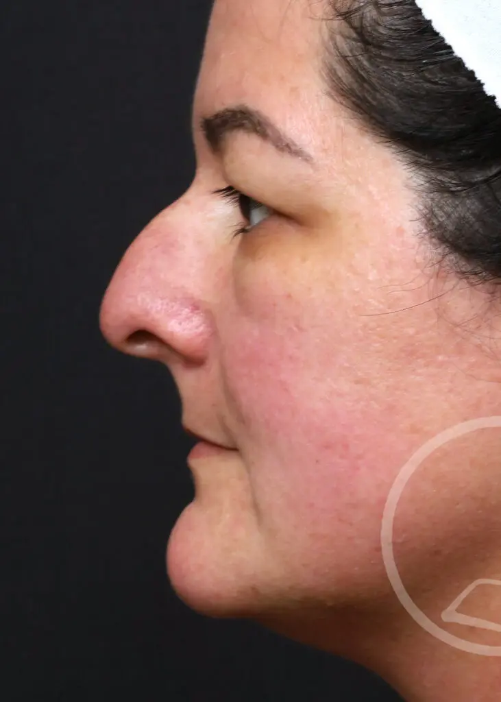 Plastic Surgery Before and After Pictures in Jacksonville, FL - Garcia Facial Plastic Surgery