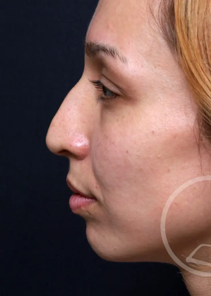 Plastic Surgery Before and After Pictures in Jacksonville, FL - Garcia Facial Plastic Surgery