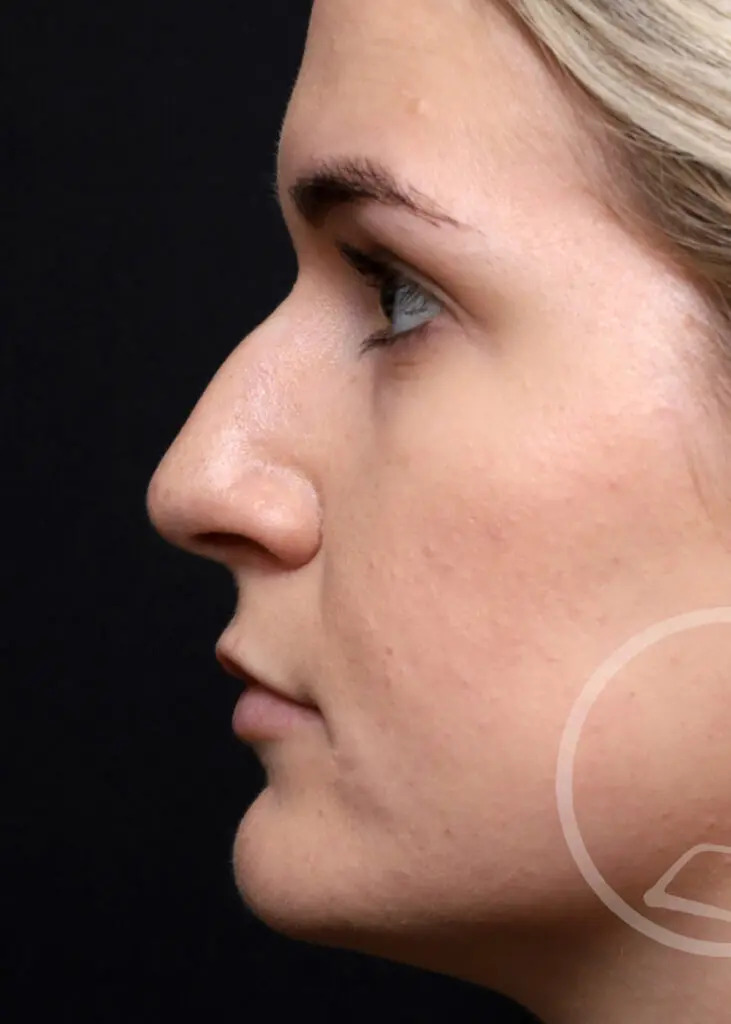Plastic Surgery Before and After Pictures in Jacksonville, FL - Garcia Facial Plastic Surgery