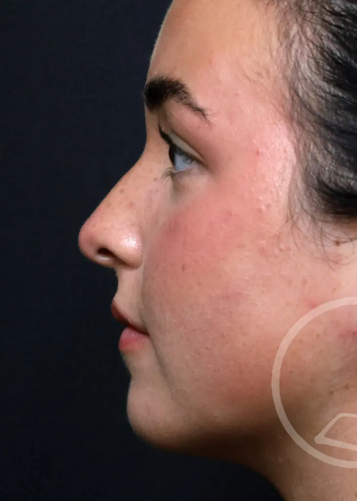 Plastic Surgery Before and After Pictures in Jacksonville, FL - Garcia Facial Plastic Surgery