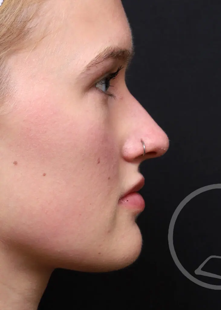 Plastic Surgery Before and After Pictures in Jacksonville, FL - Garcia Facial Plastic Surgery