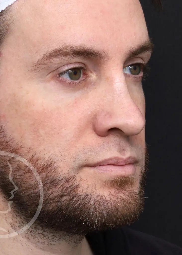 Plastic Surgery Before and After Pictures in Jacksonville, FL - Garcia Facial Plastic Surgery