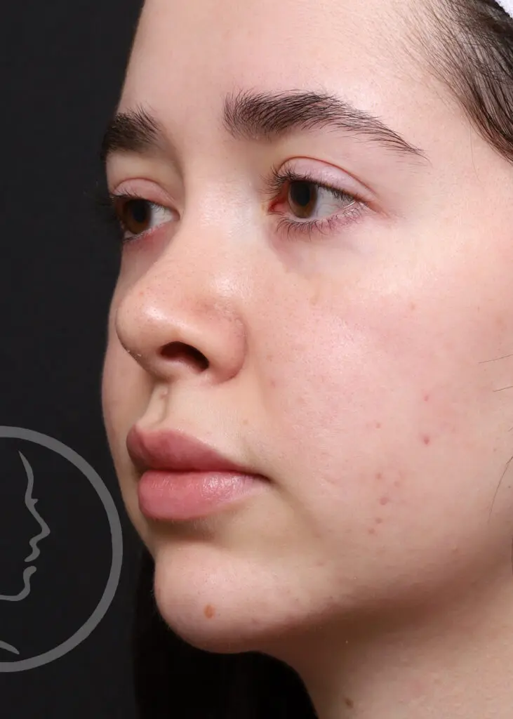 Plastic Surgery Before and After Pictures in Jacksonville, FL - Garcia Facial Plastic Surgery