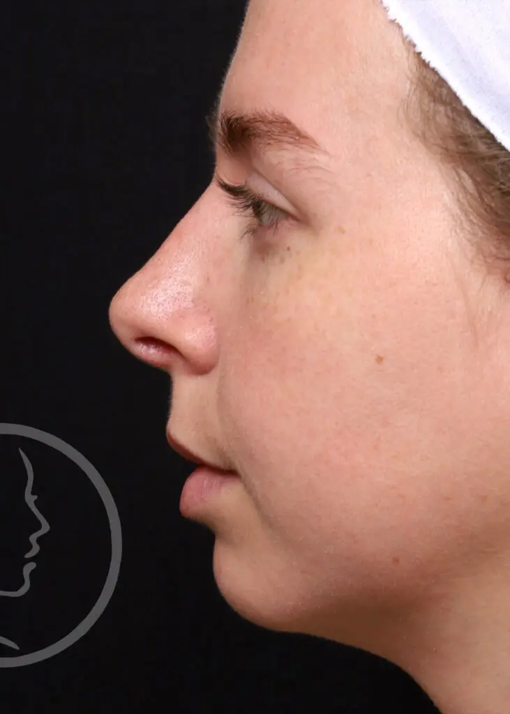 Plastic Surgery Before and After Pictures in Jacksonville, FL - Garcia Facial Plastic Surgery