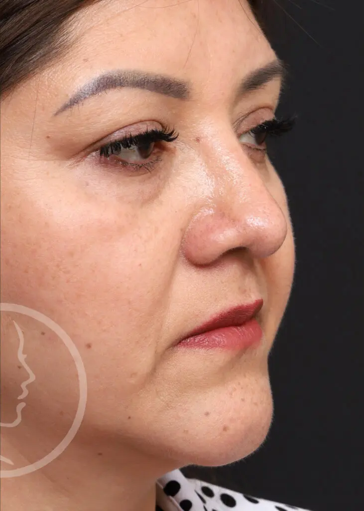 Plastic Surgery Before and After Pictures in Jacksonville, FL - Garcia Facial Plastic Surgery