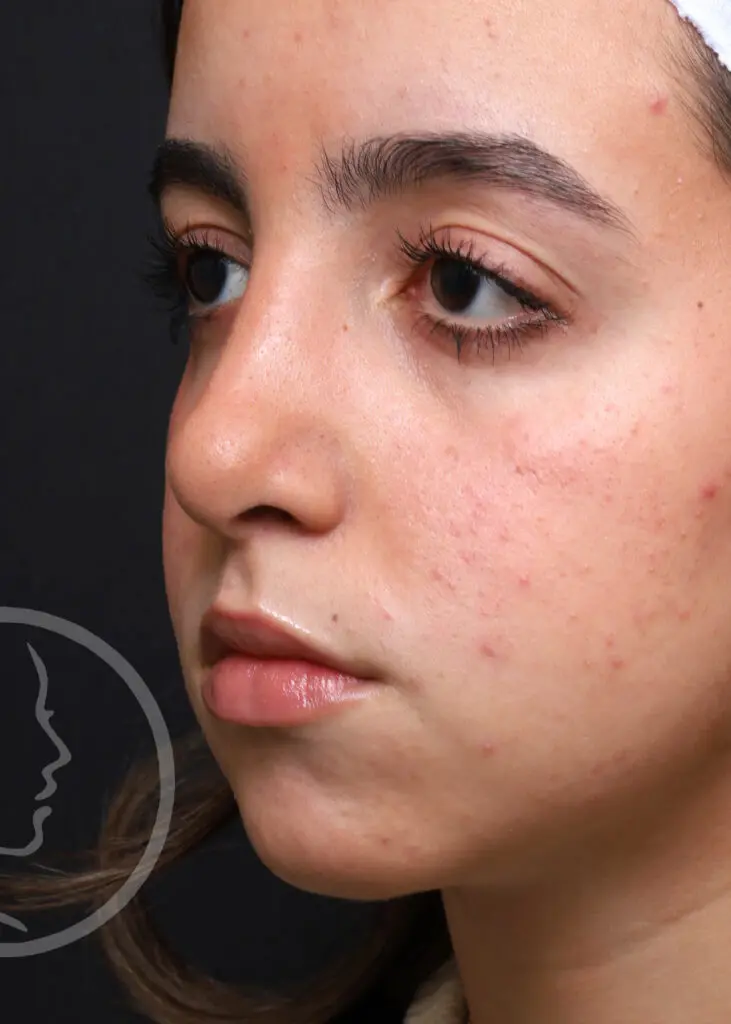 Plastic Surgery Before and After Pictures in Jacksonville, FL - Garcia Facial Plastic Surgery