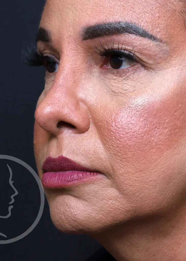 Plastic Surgery Before and After Pictures in Jacksonville, FL - Garcia Facial Plastic Surgery