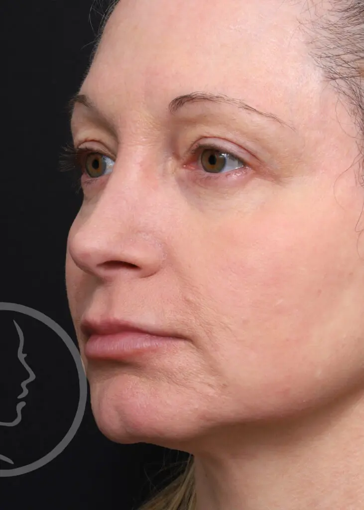 Plastic Surgery Before and After Pictures in Jacksonville, FL - Garcia Facial Plastic Surgery