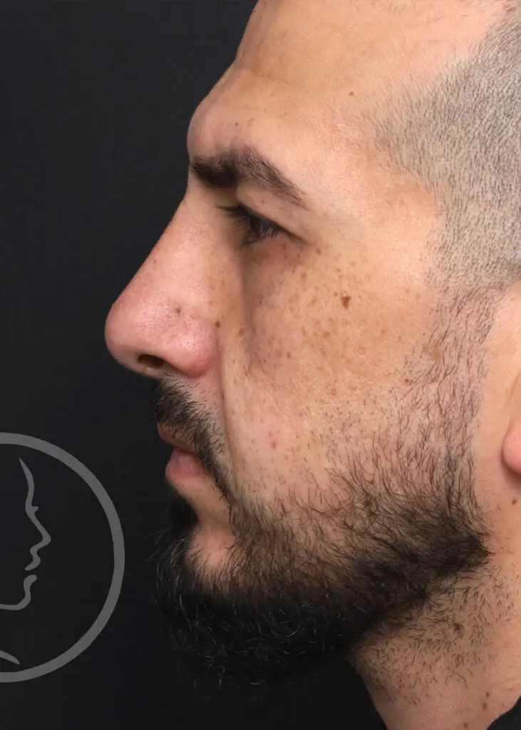 Plastic Surgery Before and After Pictures in Jacksonville, FL - Garcia Facial Plastic Surgery
