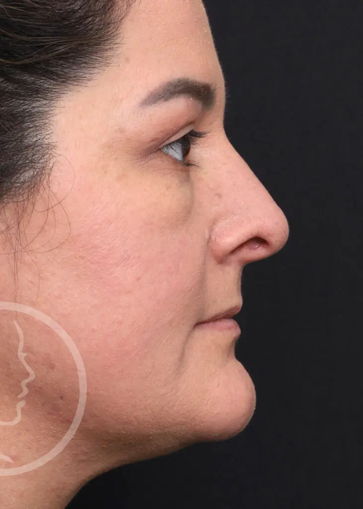 Plastic Surgery Before and After Pictures in Jacksonville, FL - Garcia Facial Plastic Surgery