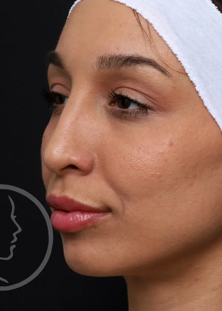 Plastic Surgery Before and After Pictures in Jacksonville, FL - Garcia Facial Plastic Surgery