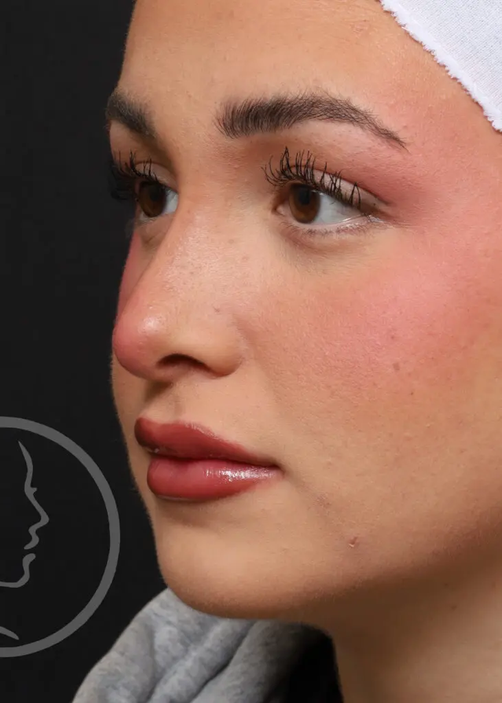 Plastic Surgery Before and After Pictures in Jacksonville, FL - Garcia Facial Plastic Surgery